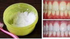 Evinizde  Doğal Yöntemler ile 2 Dakikada Beyaz Dişlere Kavuşun % 100 Sonuç