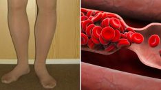 Vücudunuz bir kan pıhtısı oluştuğunda sizi uyarır: 8 işareti ihmal etmemelisiniz