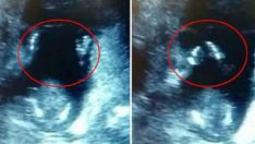 Bebeklerinin Ultrason Görüntülerini Sosyal Medyada Paylaştılar – Bebeği Görenler Yaptığına İnanamadı
