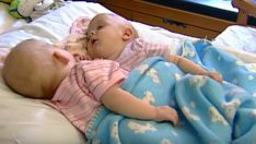 10 Yıl Önce 17 Cerrahın Yer Aldığı Operasyonla Birbirinden Ayrılan Yapışık İkizler Bakın Bugün Nasıl Görünüyorlar